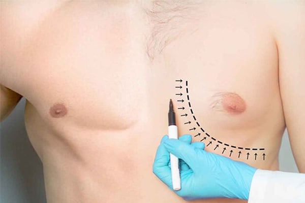 gynecomastie homme paris reduction mammaire plastie mammaire paris chirurgien esthetique plasticien paris dr montoneri