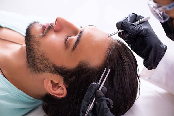 robot artas greffe de cheveux avant apres paris implant capillaire paris chirurgien esthetique plasticien paris docteur sebastiano montoneri