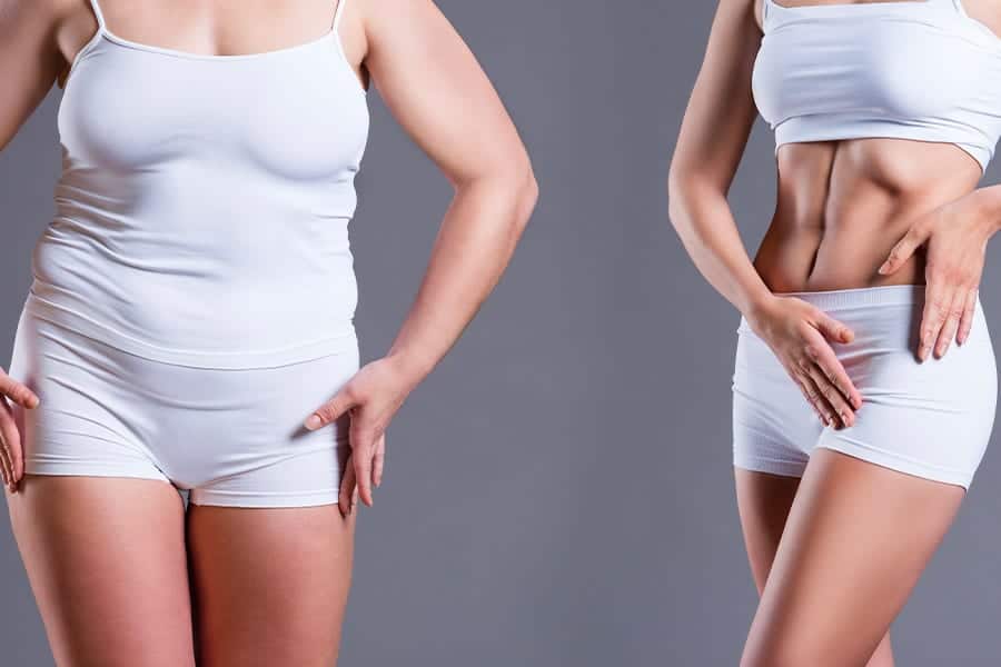 abdominoplastie resultat dr sebastiano montoneri chirurgien esthetique paris